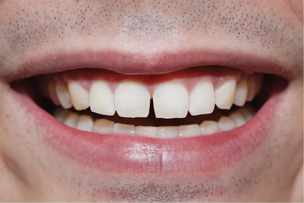 Teeth Gap
