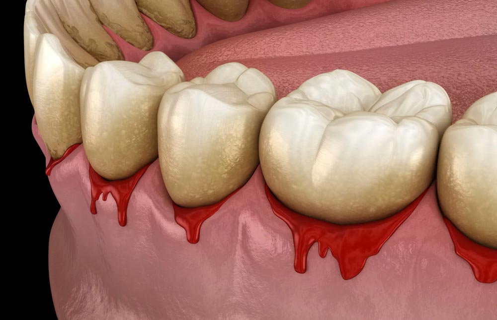 Bloody Gums