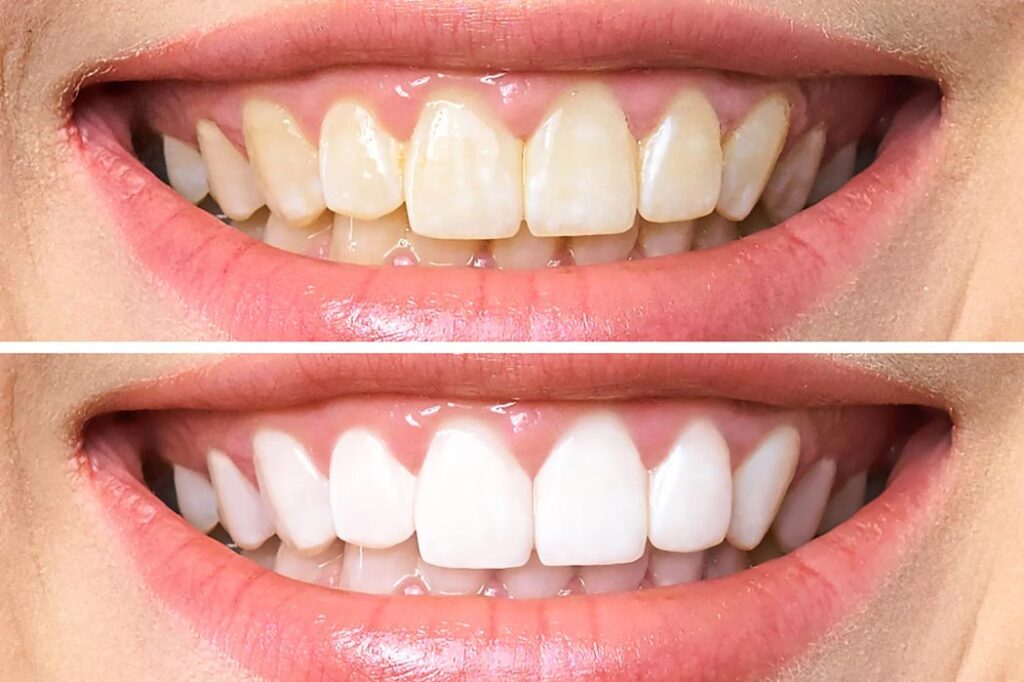 before and after of teeth