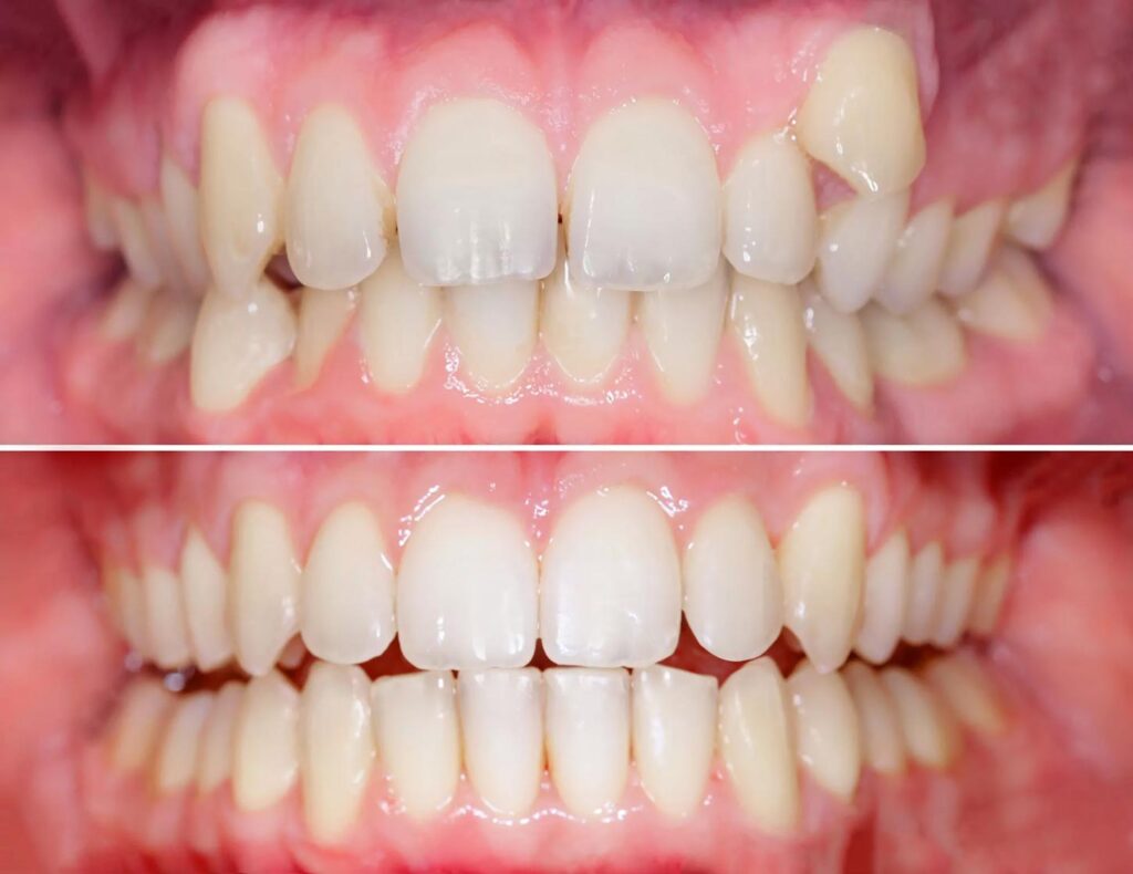 before and after image of teeth