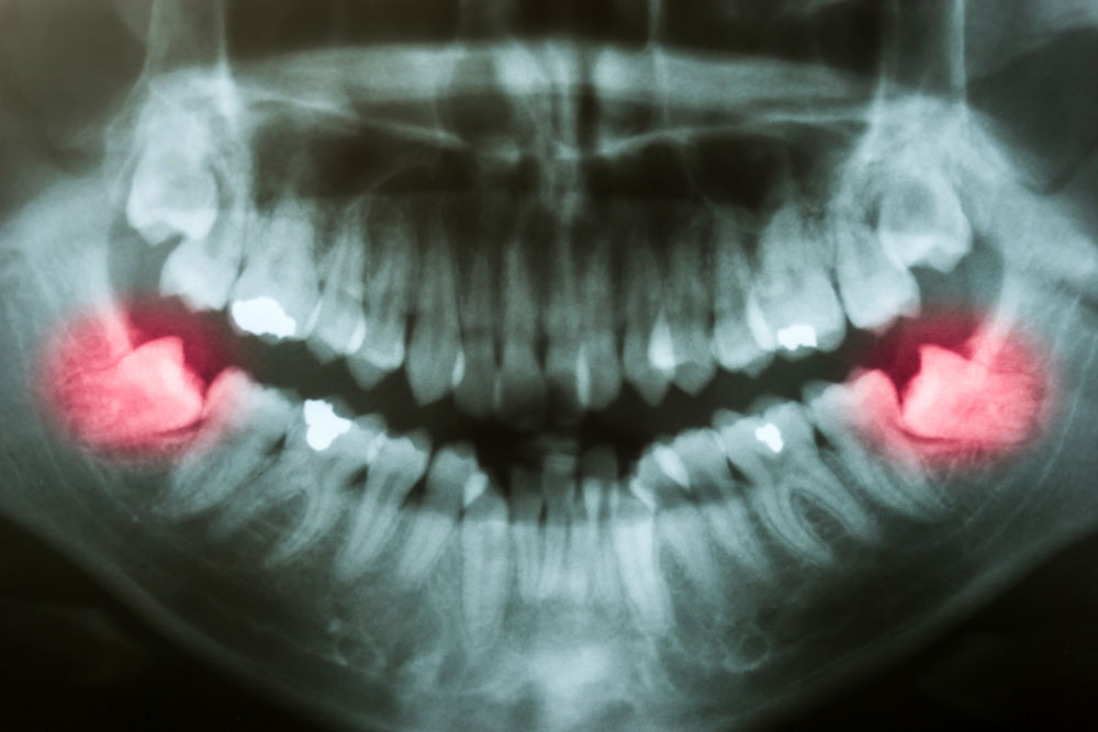 dental x-ray