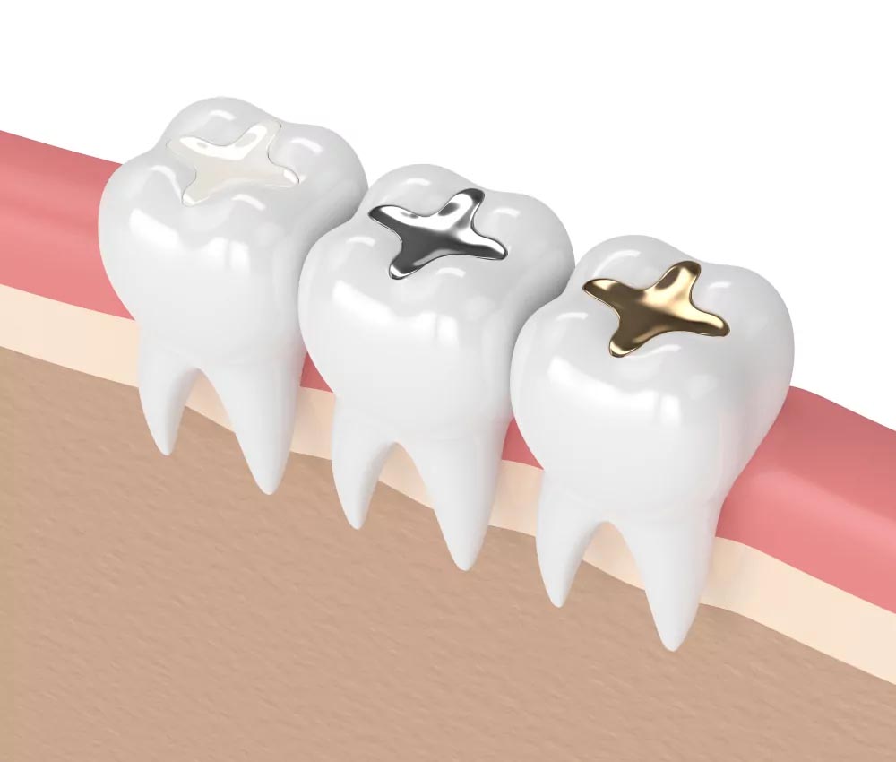 Dental Fillings