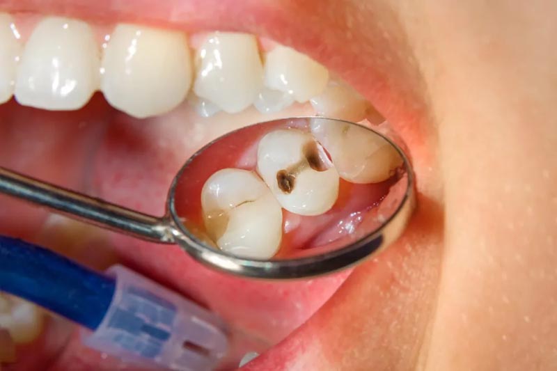 Cavity on a tooth