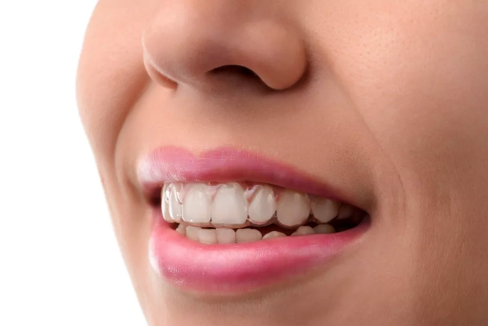A women having a Invisalign Clear Braces