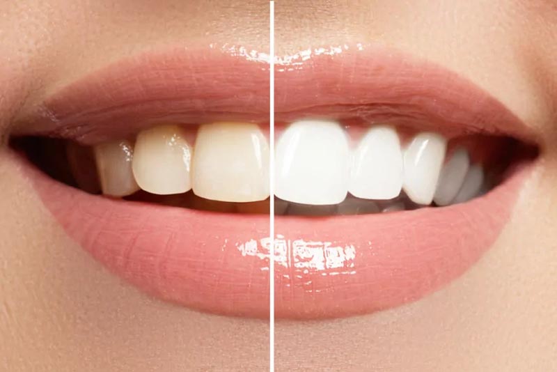 Yellow and white teeth
