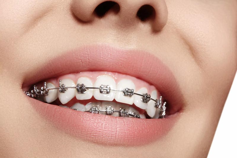 Teeth with braces on