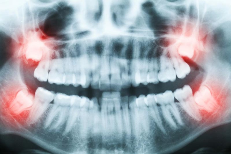 X-Ray of a jaw