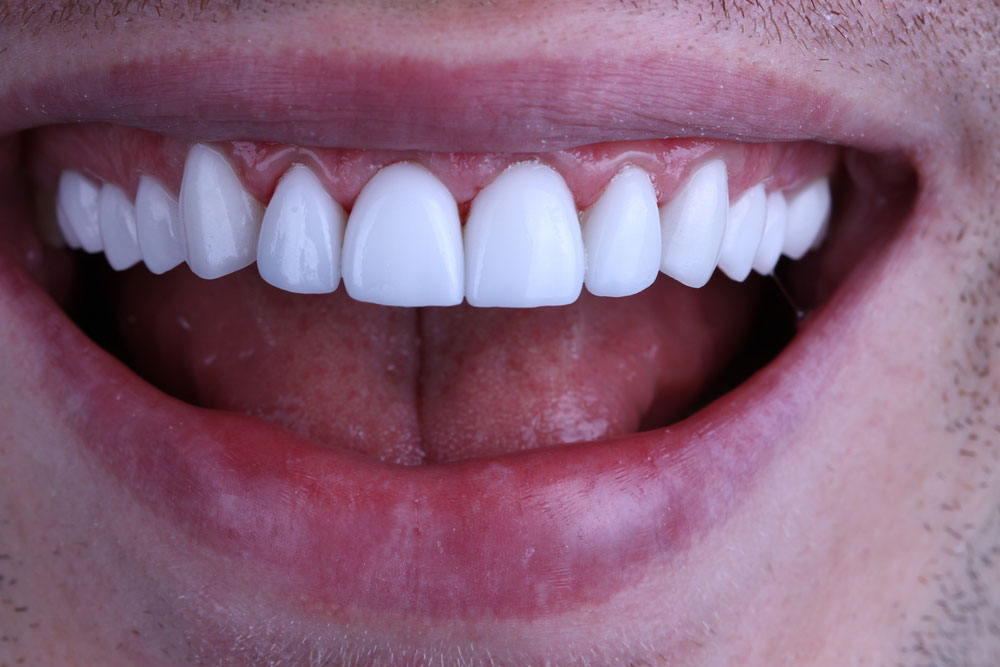 A close up of a man's mouth with white, healthy teeth