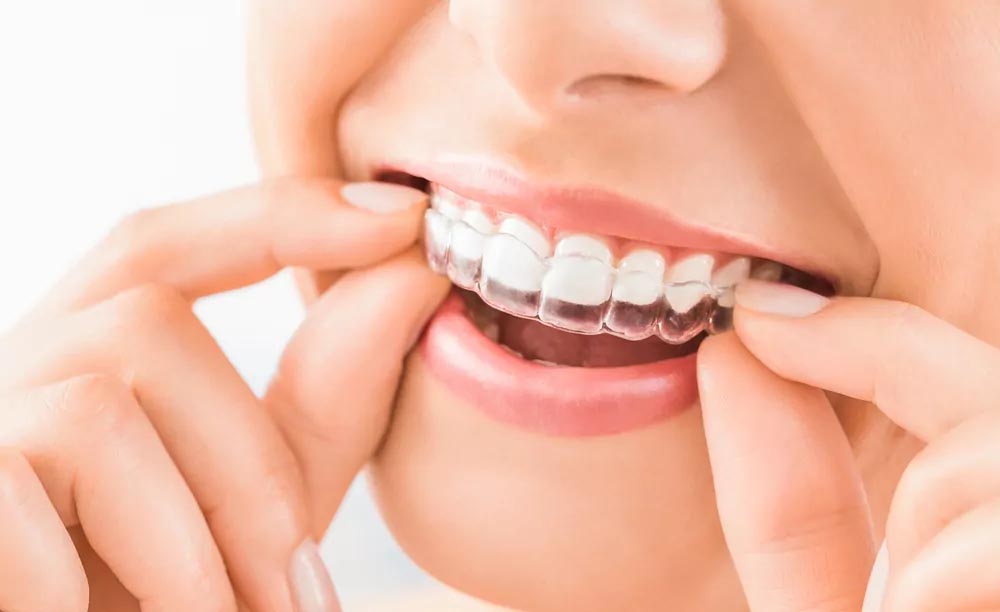 woman wearing invisalign