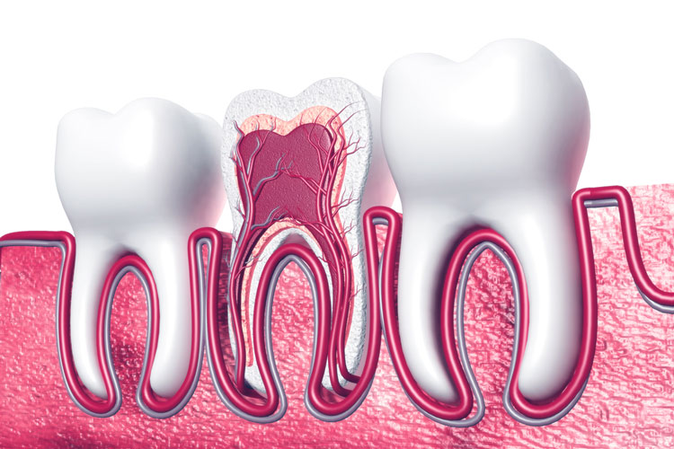 root canal treatment