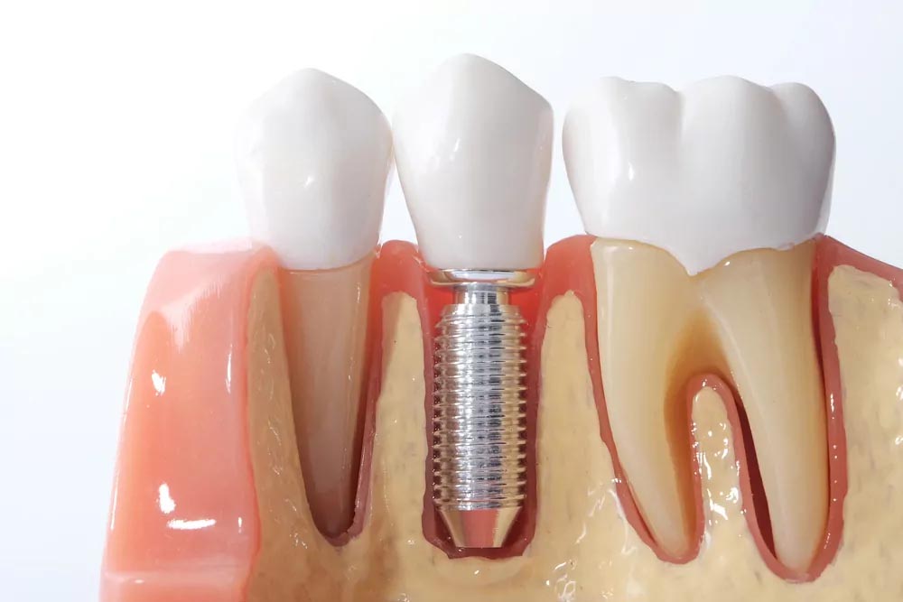 dental bridge